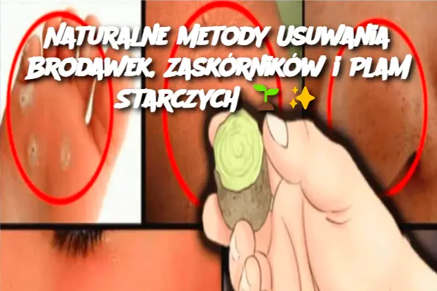 Naturalne Metody Usuwania Brodawek, Zaskórników i Plam Starczych