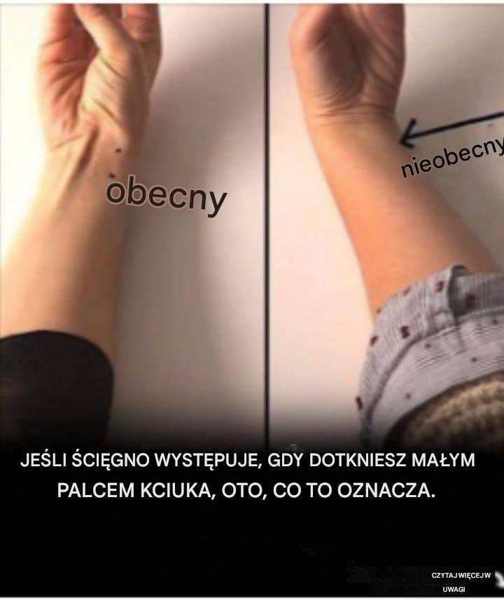 Jeśli ścięgno unosi się, gdy dotykasz małego palca kciukiem, oto co to może oznaczać