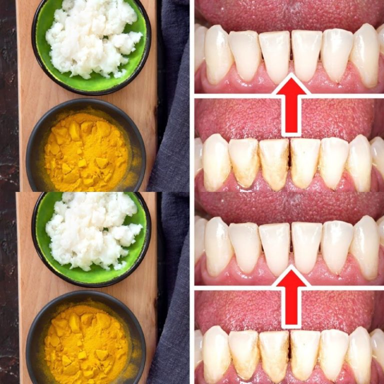 Naturalne Czyszczenie Zębów: Jak Usunąć Kamień Nazębny Bez Dentysty z Kurkumą i Solą