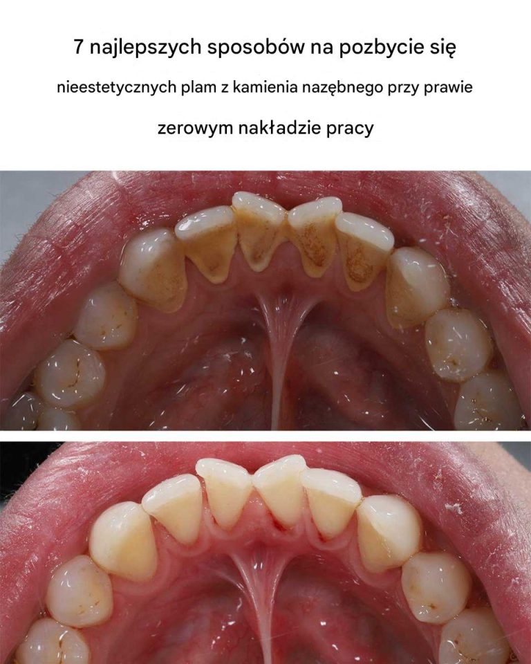 7 najlepszych sposobów na pozbycie się nieestetycznych plam z kamienia nazębnego przy prawie zerowym nakładzie pracy