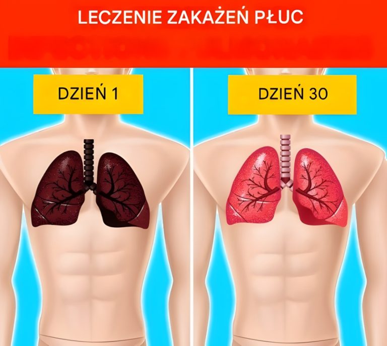 10 naturalnych sposobów leczenia infekcji płuc (domowe sposoby)