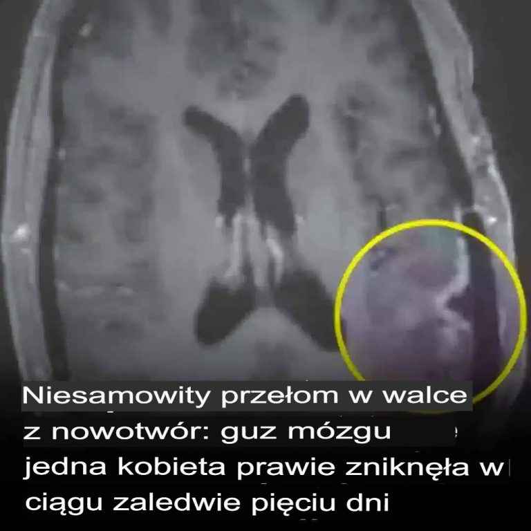 Przełom w leczeniu raka: Guz mózgu kobiety prawie zniknął w ciągu zaledwie pięciu dni